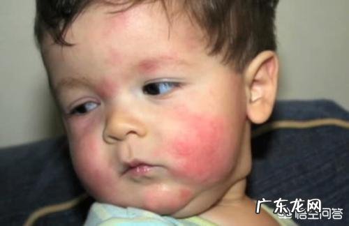 宝宝老是脸上反复起一些小红点怎么办?