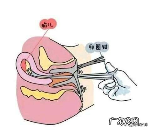 打过胎的女孩怎样看得出来?