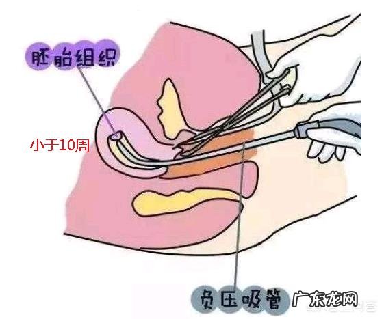 打过胎的女孩怎样看得出来?