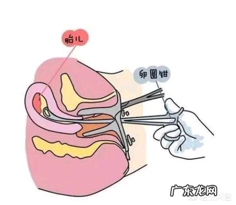 打过胎的女孩怎样看得出来?