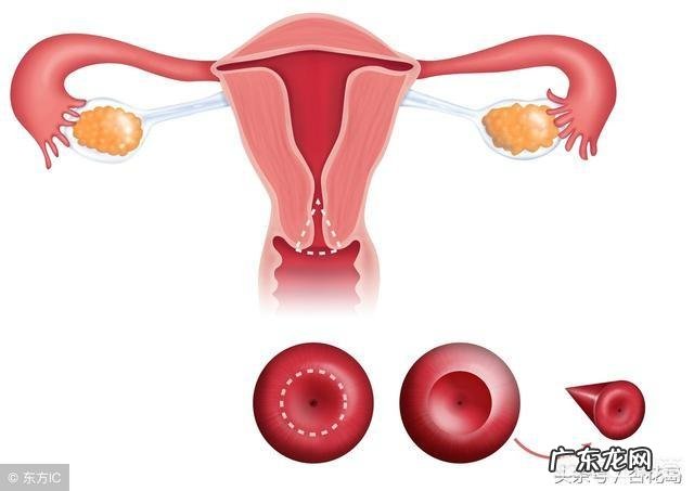 宫颈糜烂是癌变的征兆吗?