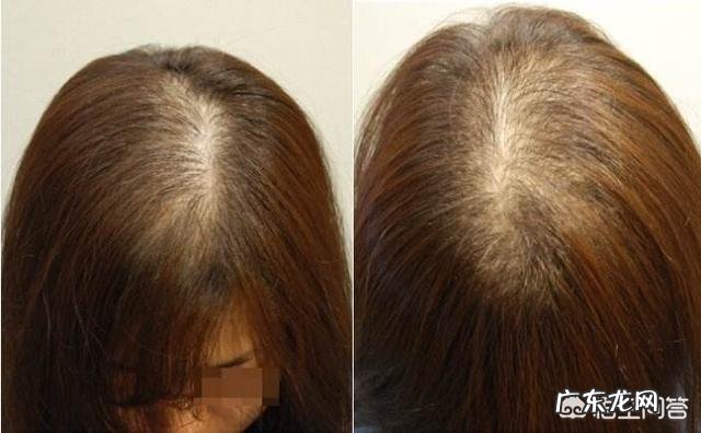 头发稀疏怎么办？