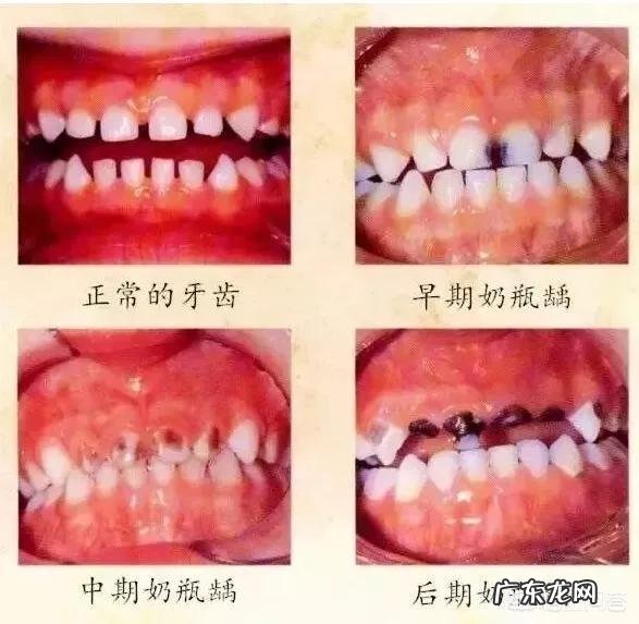 “奶瓶龋”是什么?奶瓶龋齿产生的原因及预防方法?