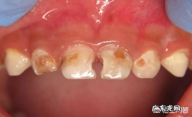 “奶瓶龋”是什么?奶瓶龋齿产生的原因及预防方法?