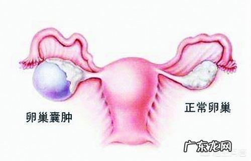 想问一下卵巢囊肿有什么症状?