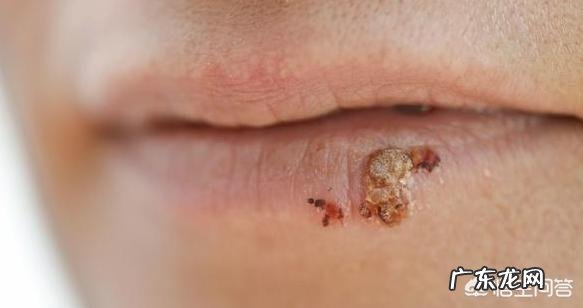 丙型肝炎是通过什么途经传染的?