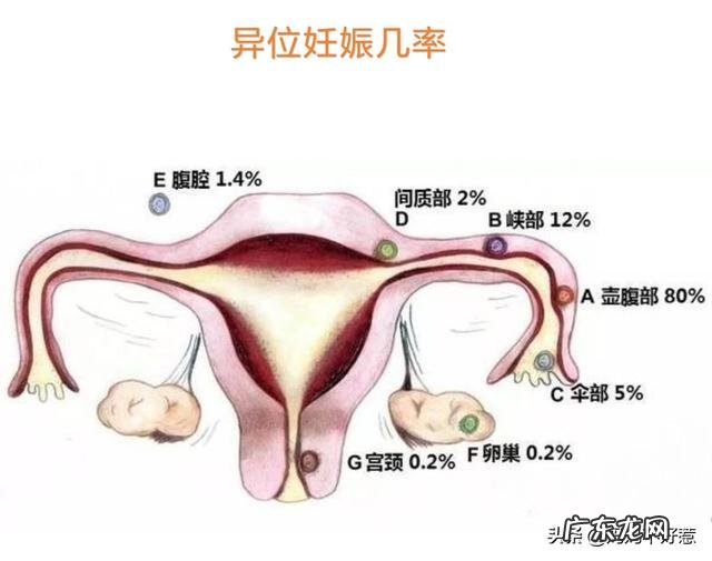 宫颈孕四十天,还能游回子宫里吗?