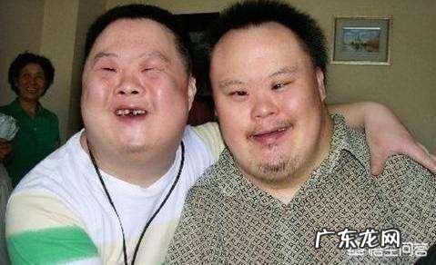 唐氏综合症有什么特征?如何辨别宝宝是不是唐氏综合症?