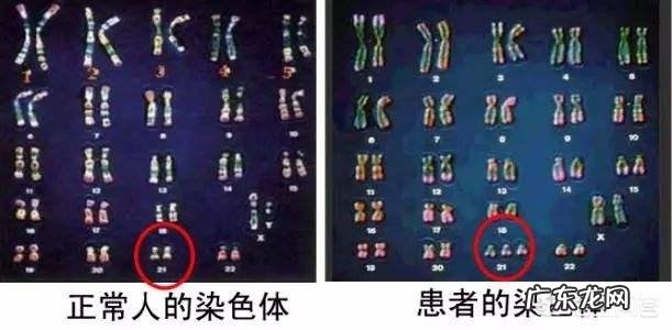 唐氏综合症有什么特征?如何辨别宝宝是不是唐氏综合症?