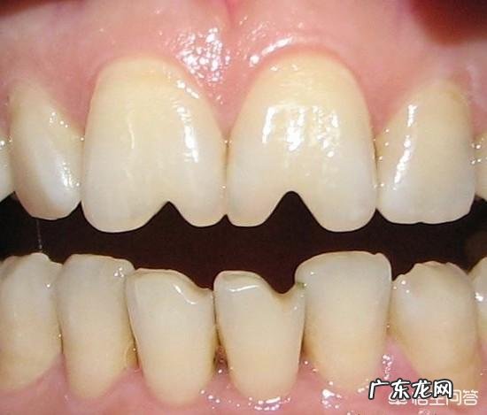 瓜子牙是什么意思?