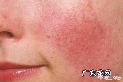 怎么缓解皮肤过敏，过敏了怎么办？