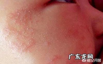 脸上奶癣怎么护理?
