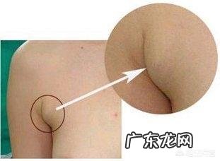 女性的副乳是什么？它会癌变吗？怎么去除副乳呢？