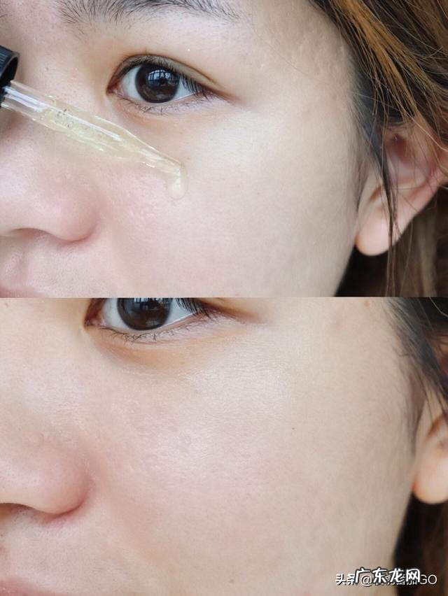 姜片可以去除痘坑吗?