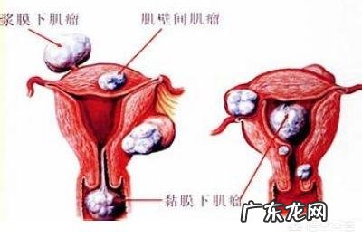 最年轻的子宫肌瘤病人年仅19岁？妇女应如何预防子宫肌瘤呢？
