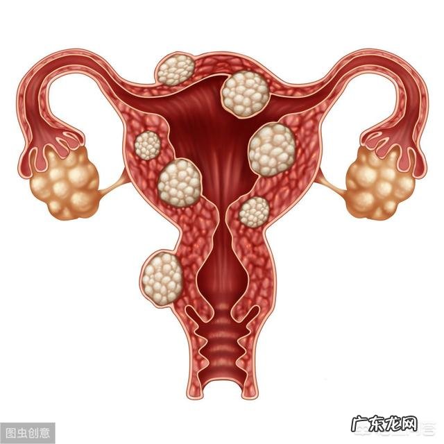 最年轻的子宫肌瘤病人年仅19岁?妇女应如何预防子宫肌瘤呢?