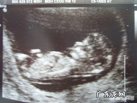 早期唐氏筛查和NT要不要做?