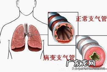 哮喘病能治好吗?