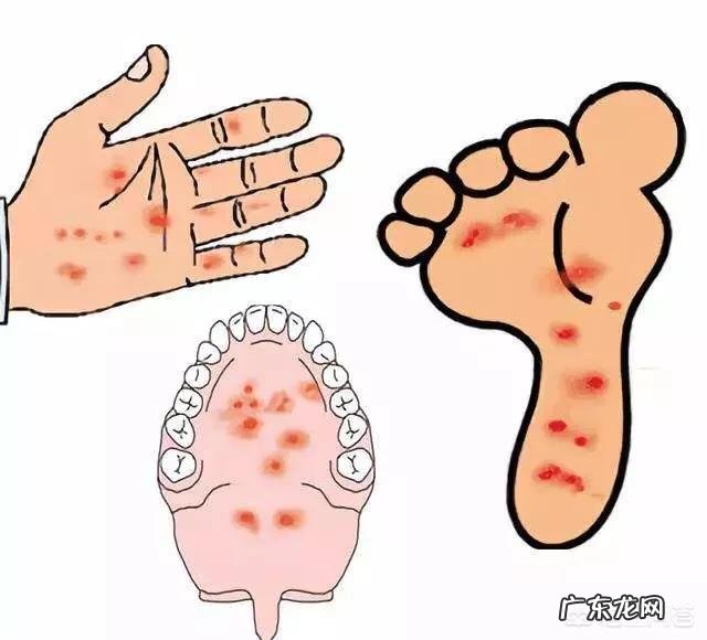 如何预防儿童“手足口病”?