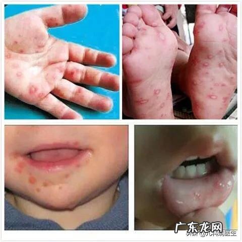 如何预防儿童“手足口病”?