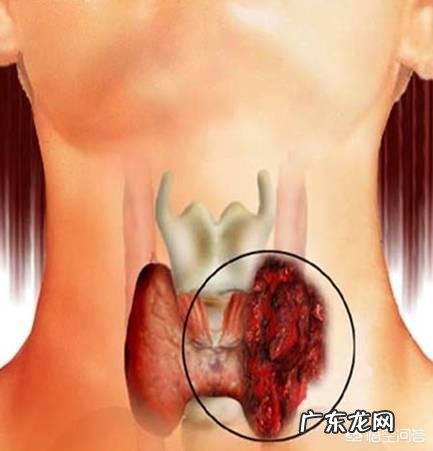 90%的甲状腺癌都可以治愈吗?有什么依据?