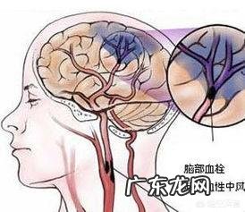 脑梗为什么容易复发，到底能不能治愈？