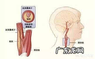 脑梗为什么容易复发，到底能不能治愈？