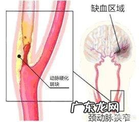 脑梗为什么容易复发，到底能不能治愈？