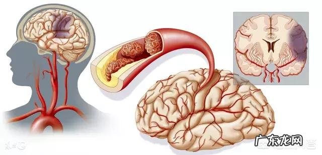脑梗为什么容易复发,到底能不能治愈?