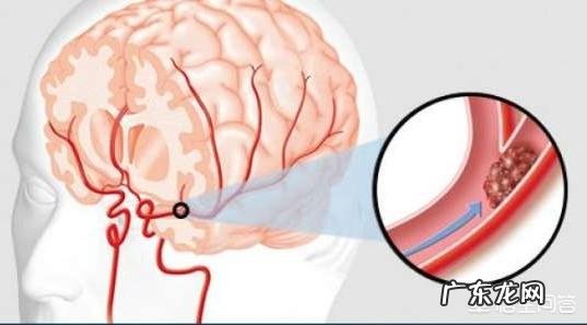 脑梗为什么容易复发,到底能不能治愈?