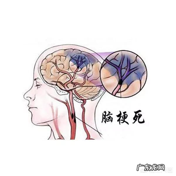 脑梗为什么容易复发,到底能不能治愈?