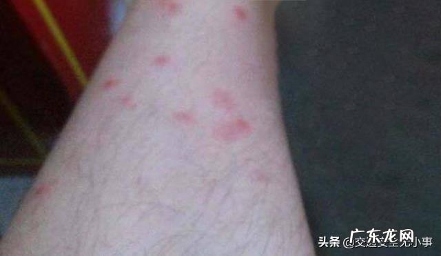 被跳蚤咬了很多包。怎么办？