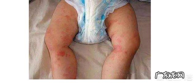 宝宝湿疹是怎么引起的,该怎样缓解?