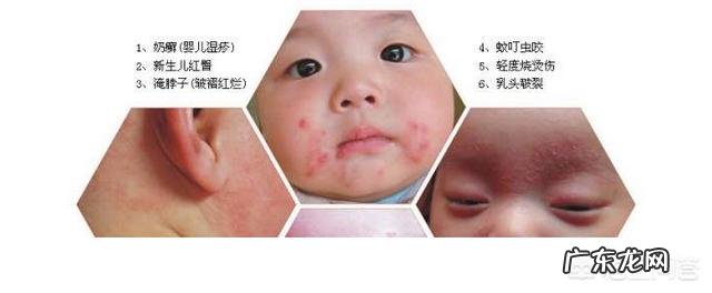 宝宝湿疹是怎么引起的,该怎样缓解?