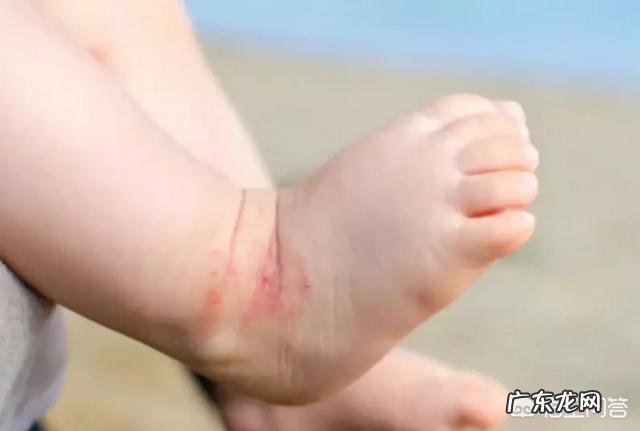 宝宝湿疹是怎么引起的,该怎样缓解?