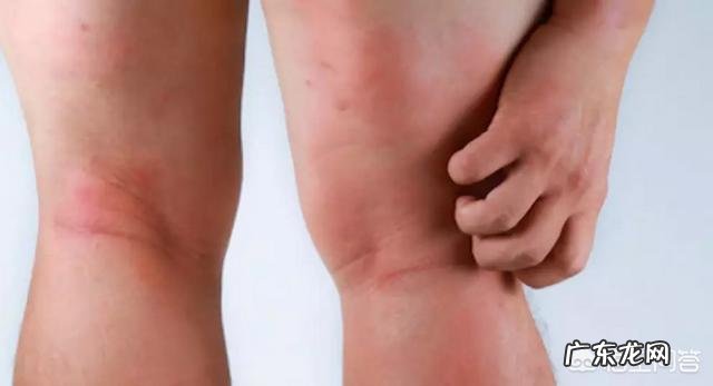 宝宝湿疹是怎么引起的,该怎样缓解?