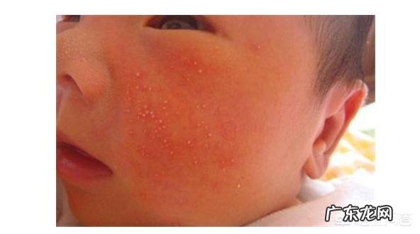 宝宝湿疹是怎么引起的,该怎样缓解?