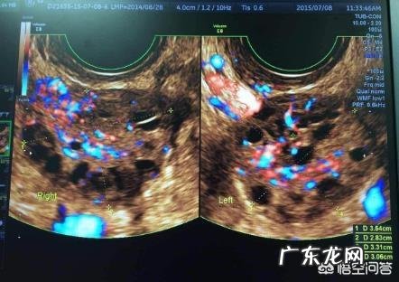 卵巢卵泡太多，营养不够，不能形成成熟的卵子，该补充哪些营养？