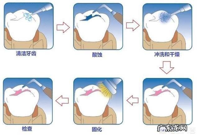 孩子的牙齿为什么要做窝沟封闭?什么是窝沟封闭?