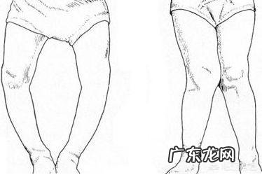 3个月宝宝佝偻病能治好吗?