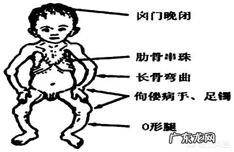 3个月宝宝佝偻病能治好吗?