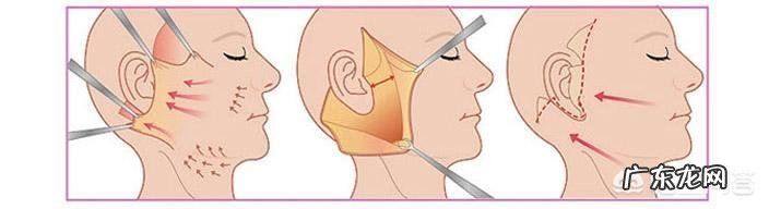 如何去除额头的皱纹?