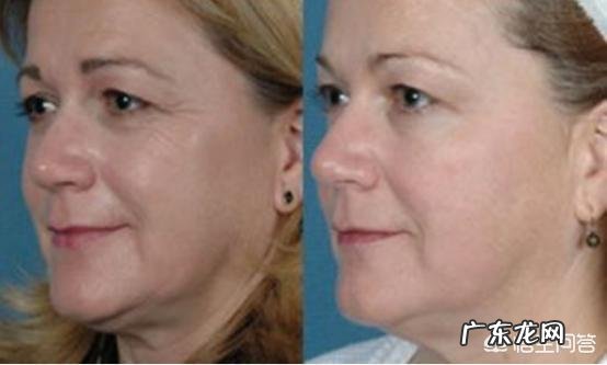 如何去除额头的皱纹?