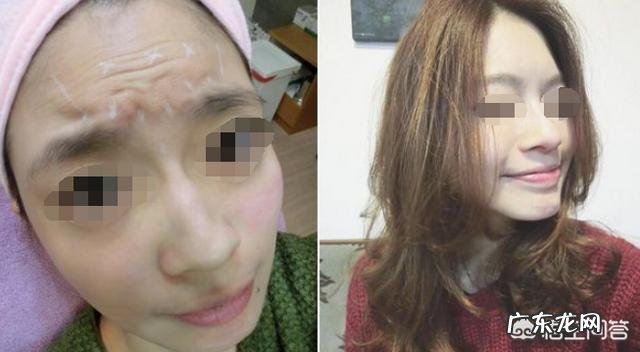 如何去除额头的皱纹?