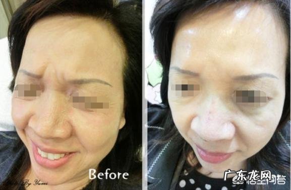 脸上的皱纹多是怎么回事?