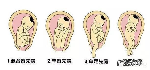 为什么现在有的医院不主张胎位纠正了?为什么?