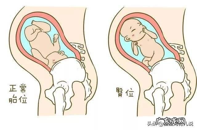 为什么现在有的医院不主张胎位纠正了?为什么?