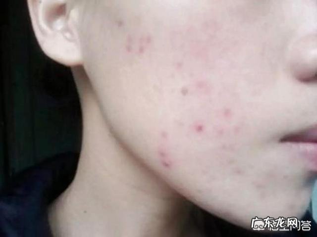 全脸都是痘印和痘坑，应该怎么护理？