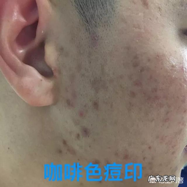 全脸都是痘印和痘坑,应该怎么护理?