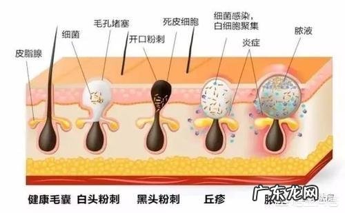全脸都是痘印和痘坑，应该怎么护理？